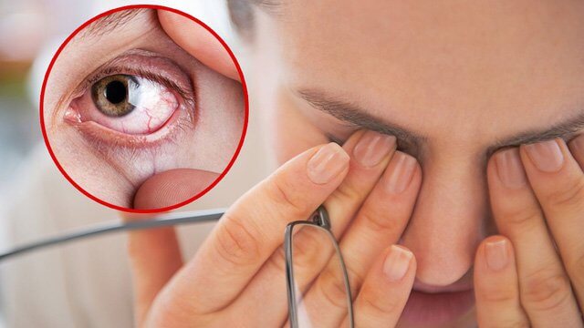 Tác hại của việc mổ mắt cận thị bạn nên biết và cân nhắc