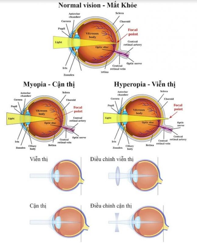 So sánh tật cận thị và viễn thị, cách khắc phục hiệu quả