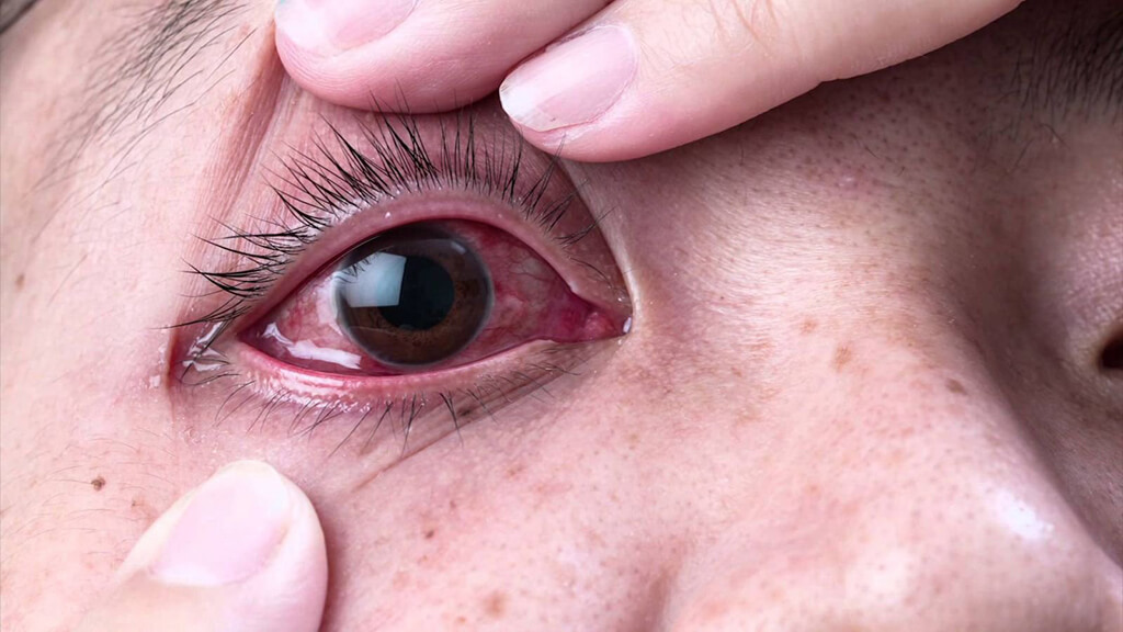 Cách chữa đau mắt hàn nhanh nhất tại nhà hiệu quả